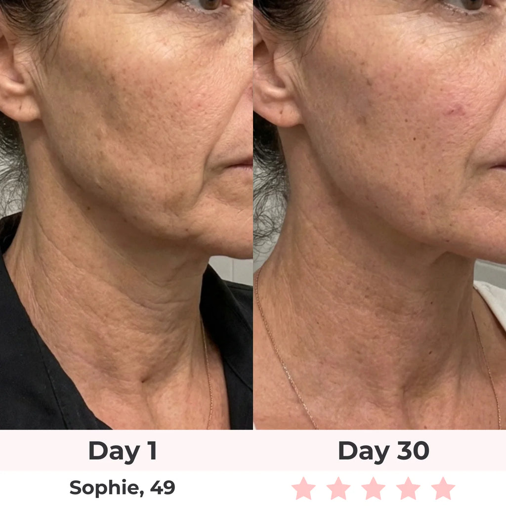 Lumatra 3-in-1 LED Facial Sculptor